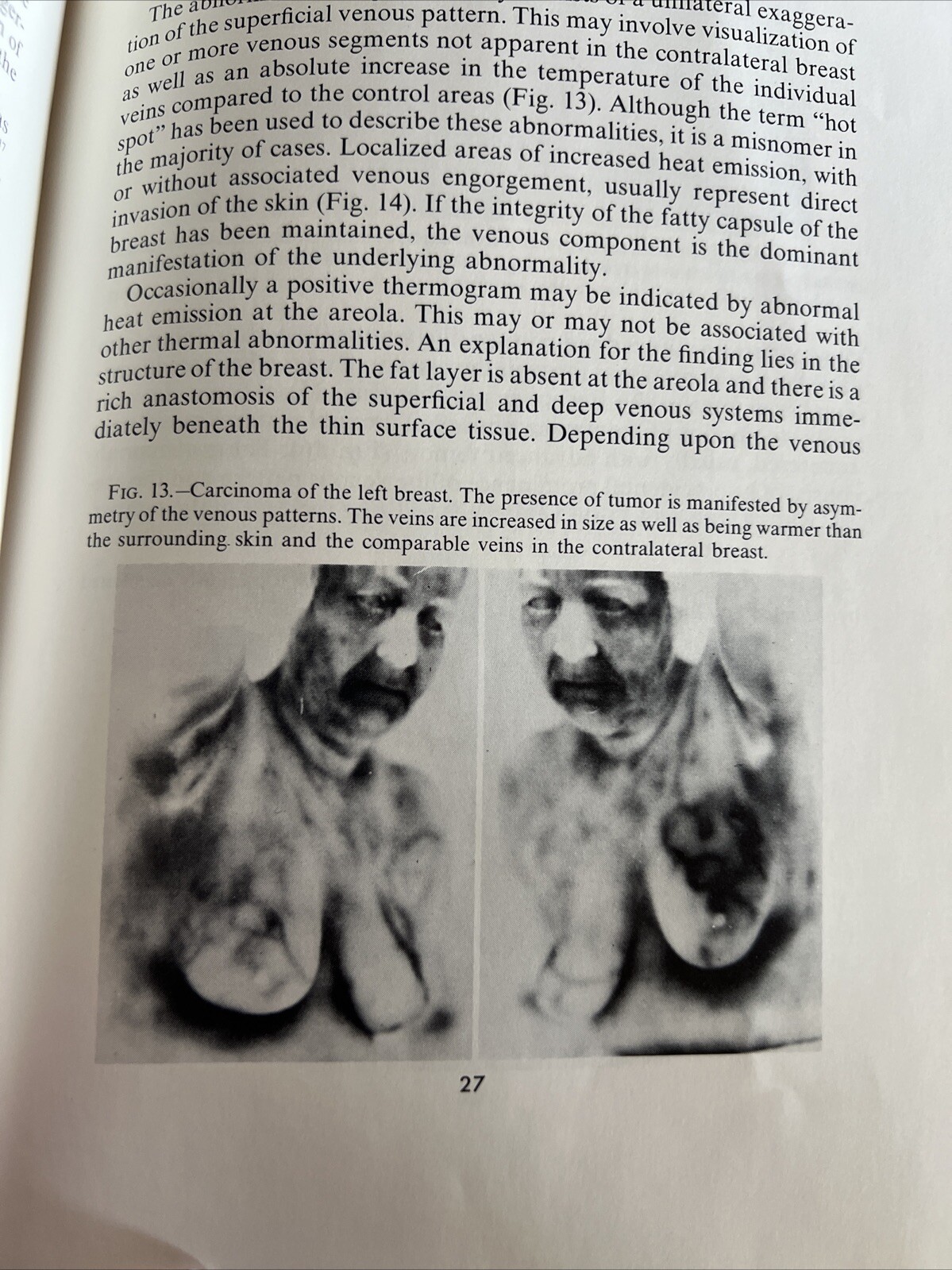 CURRENT PROBLEMS IN Radiology Breast Thermography The State Of The Art Paperback