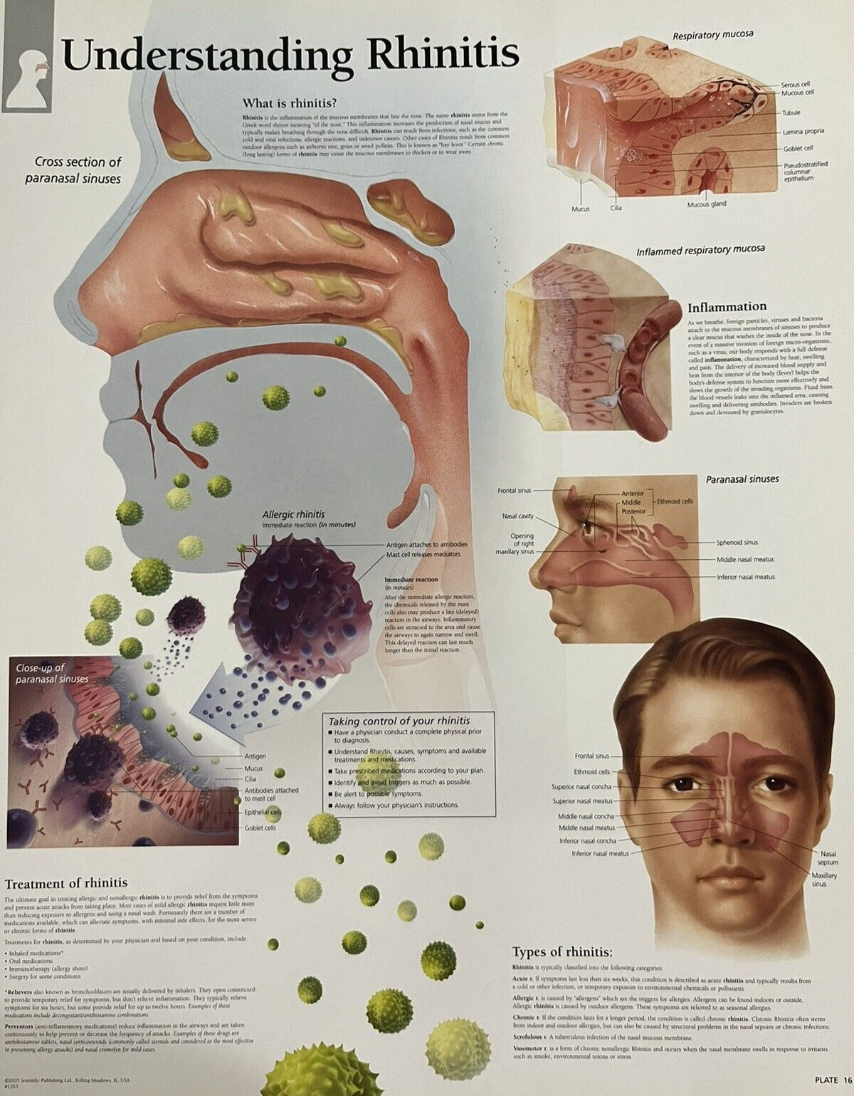 Understanding Rhinitis ~ Anatomy Poster ~ 11.25 x 14 inches