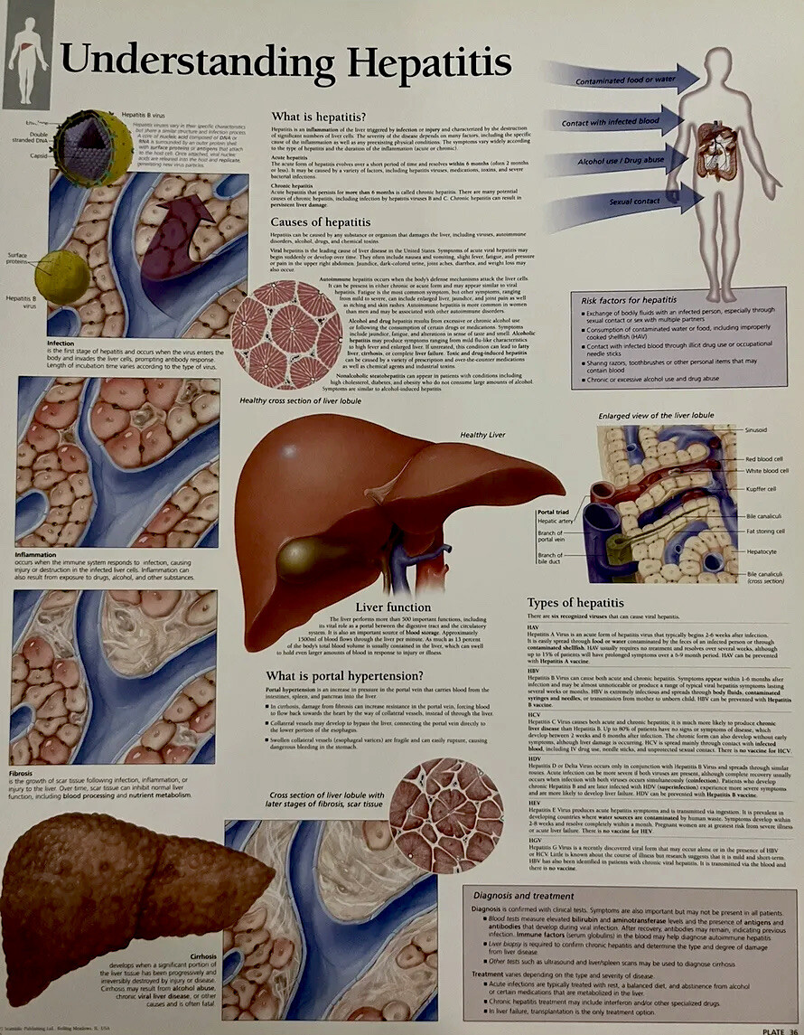 Understanding Hepatitis ~ Anatomy Poster ~ 11.25 x 14 inches
